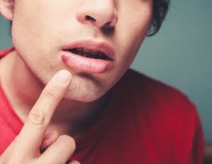 Lippenherpes