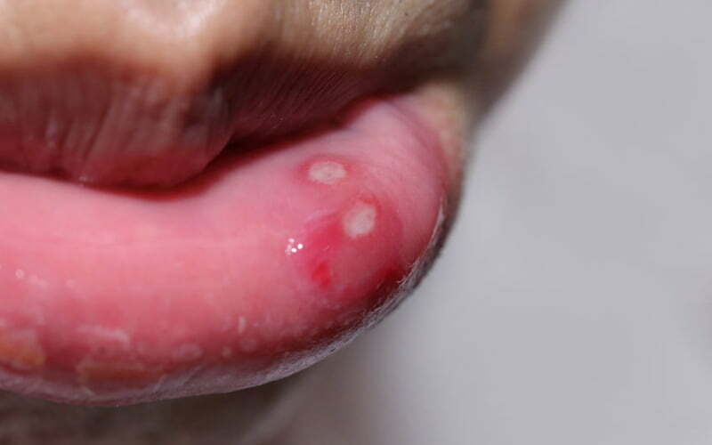 Lippenherpes